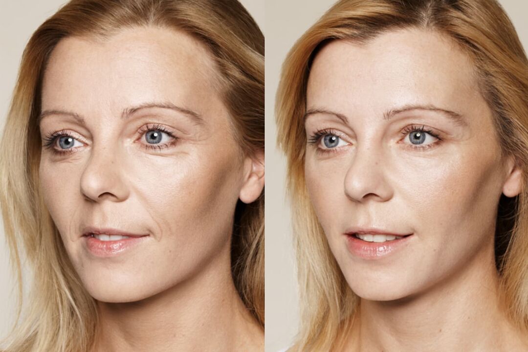 Esperienze d'uso prima e dopo l'utilizzo della crema intenskin di Valeria