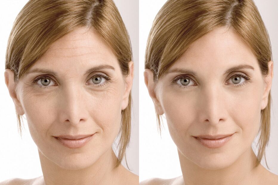 Esperienze di utilizzo prima e dopo l'utilizzo della crema intenskin di Milana